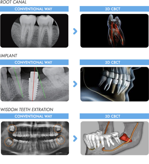 graph overview of root canal, implants and wisdom teeth procedures