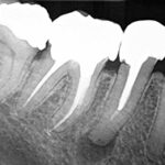 root canal xray