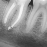 xray of root canal